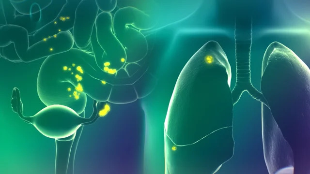 Imagen: CYTALUX es el único agente de imágenes dirigido diseñado para "resaltar" el cáncer de ovario y de pulmón en el cuerpo (Fotografía cortesía de On Target)